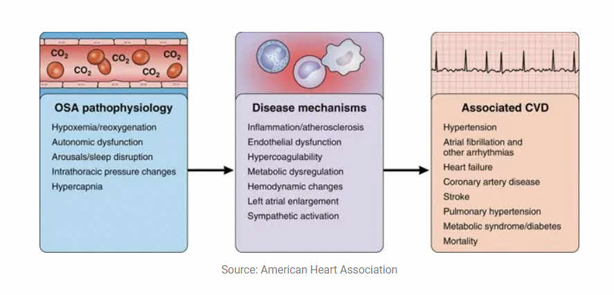 sleep apnea