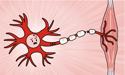 great eastern lifepedia Amyotrophic Lateral Sclerosis (ALS) neurodegenerative disease symptoms